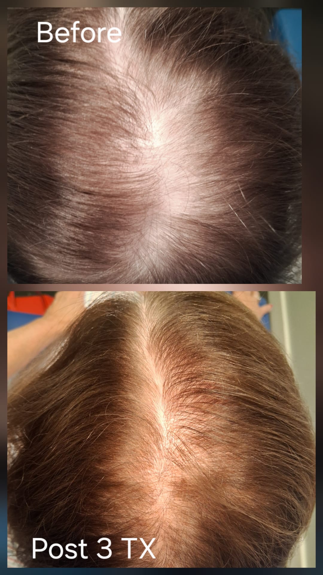 Hair restoration result